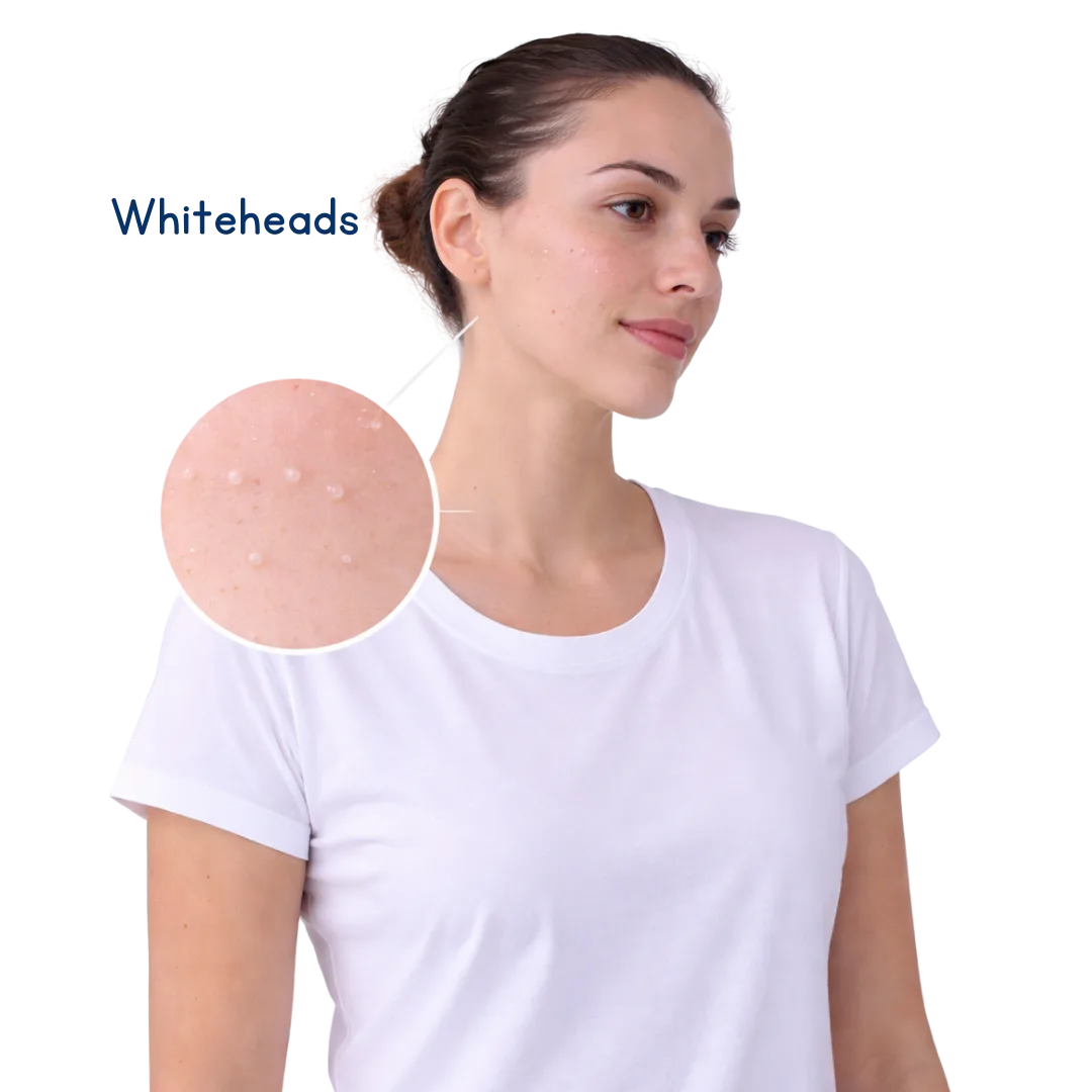 Acne Treatment 2