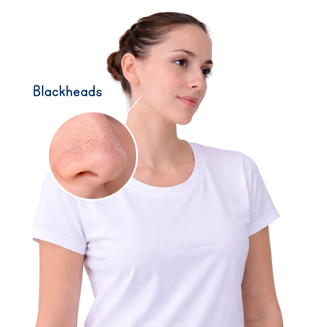 Acne Treatment 4