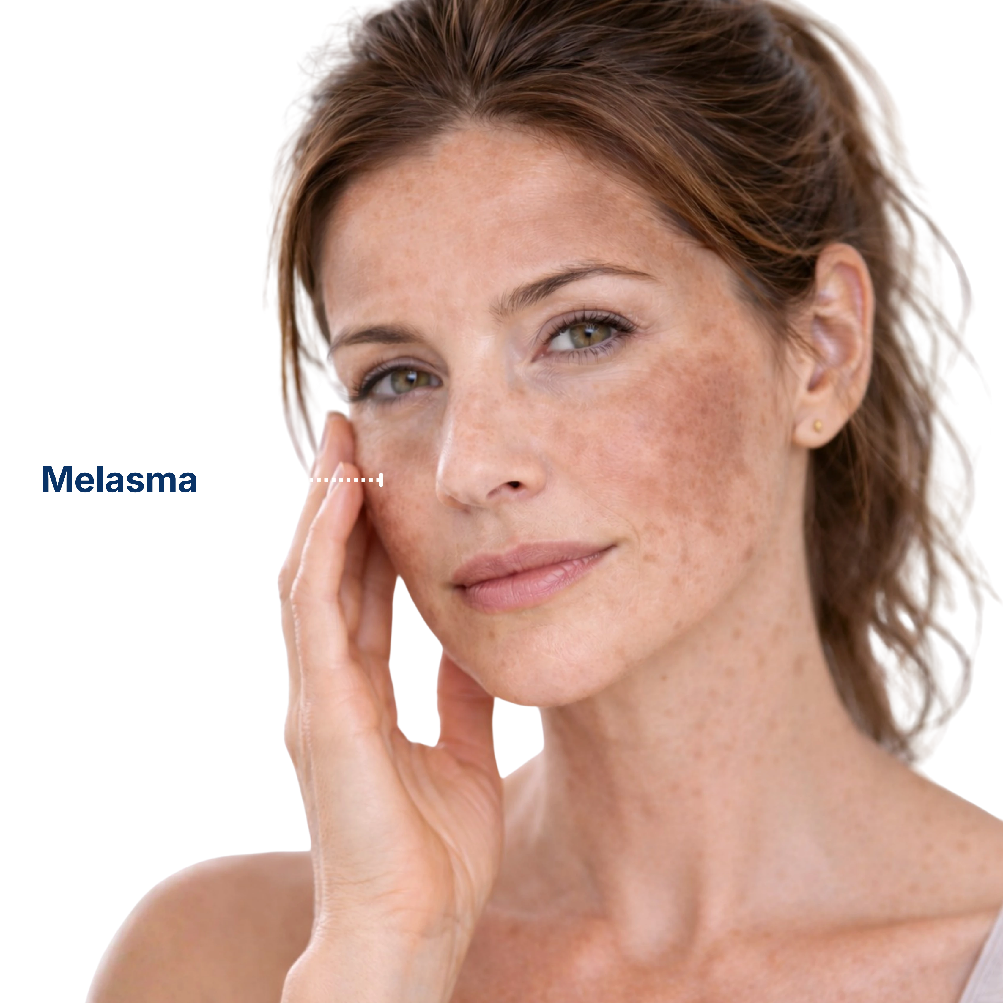 Pigmentation Treatment 3